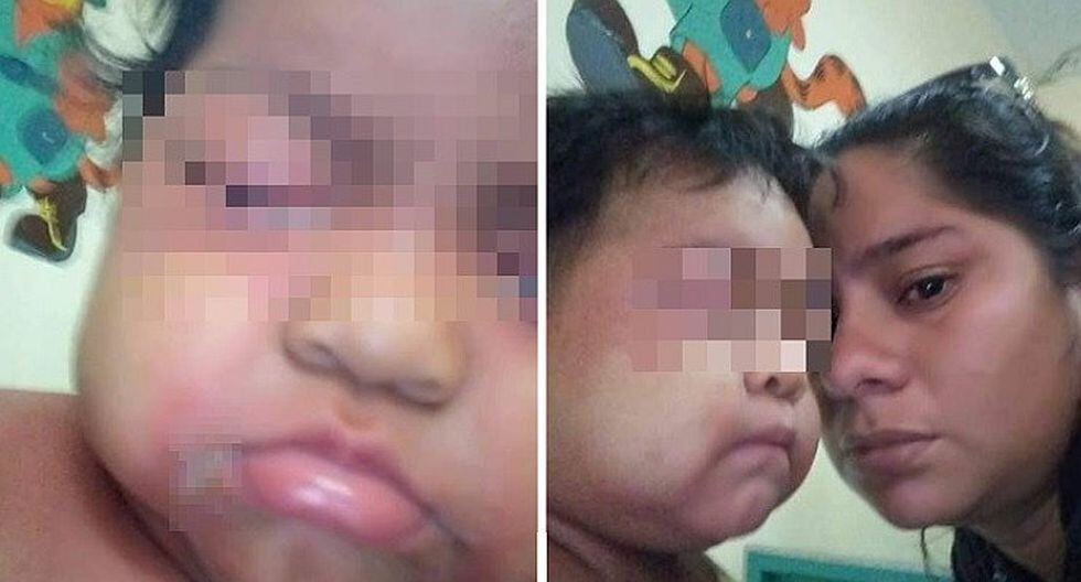 Bebé de un año padece el síndrome de Stevens-Johnson y necesita ayuda urgente (FOTOS)