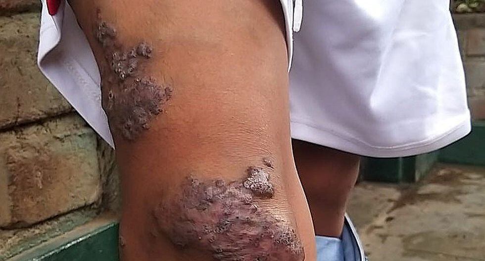 Niño con rara malformación busca vencer la enfermedad y llevar una vida normal